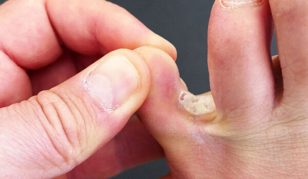 Tratamento de frieira - Doctor Feet Podologia