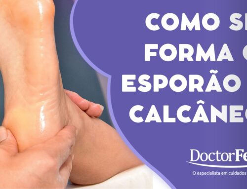 Dor no calcanhar: pode ser fascite plantar. Doctor Feet Podologia