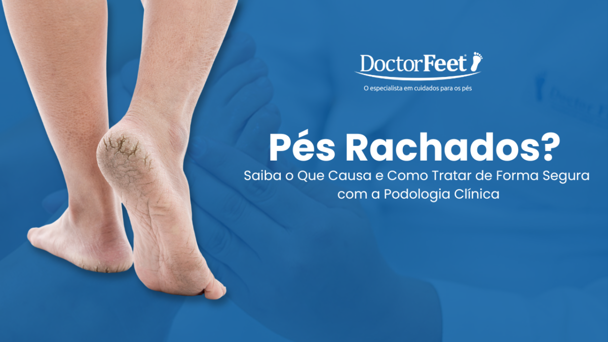 Pés Rachados? Saiba o que causa e como tratar de forma segura
